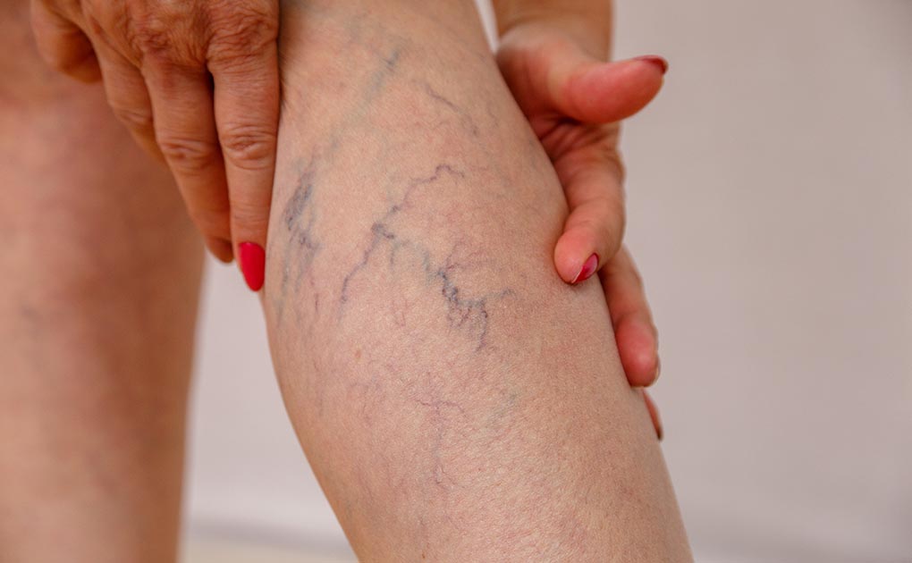 does-insurance-cover-spider-vein-treatment